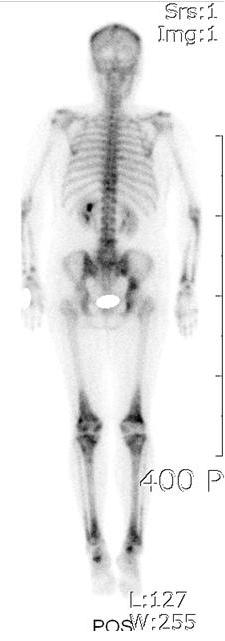 뼈스캔에서는우측관골구 (acetabulum), 양측대퇴골의원위부골간단 (metadiaphysis) 과경골 (tibia) 에강한방사능이관찰되었다 (Fig. 4).