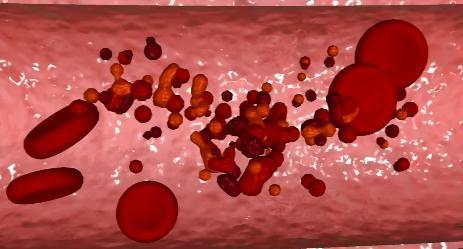 2원인 : 많은환자에서 PIG-A 유전자의돌연변이가원인이라고밝혀졌는데비정상적인조혈모세포에서적혈구막형성에이상을가진적혈구가생성되며, 이적혈구가보체와의비정상적인반응을보이게되어용혈현상이일어남. 따라서발작성야간혈색소뇨증적혈구를정상인에게수혈했을때는적혈구수명이단축되지만정상적혈구를발작성야간혈색소뇨증환자에게수혈했을경우에는수혈한정상적혈구의수명은정상임.