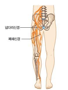허리신경얼기마비 lumbar plexus paralysis, T12~L4 허리신경얼기마비는엉덩굽힘근 (hip flexors) 과무릎폄근 (knee extensors) 및넓적다리 (thigh) 의가쪽돌림근 (external rotators)