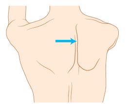 긴가슴신경마비 long thoracic nerve palsy 긴가슴신경은어깨뼈앞쪽에있는앞톱니근 (serratus anterior) 을지배하는신경으로,