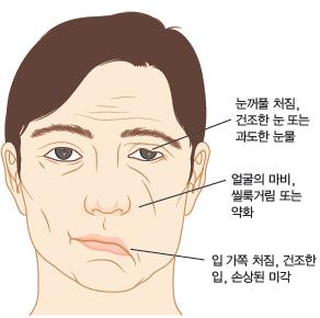 얼굴신경마비 facial nerve palsy 얼굴신경마비는제 7 뇌신경인얼굴신경의손상으로인하여주로얼굴표정근 (expression muscles) 에이상이나타나고통증이나타나는질환이다.