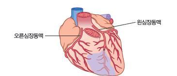 심장동맥질환 coronary artery disease 심장동맥은심장에혈액을공급하는혈관으로혈관이고령 (50 세이상 ), 콜레스테롤, 운동부족, 흡연, 고혈압, 비만, 당뇨등으로인해혈전이생겨점점좁아져서막히게되는질환을심장동맥질환이라한다 가슴조임증 angina