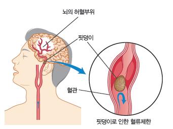 중추신경계 (central nervous system) 질환 뇌혈관장애 cerebral vascular accident 뇌졸중 (stroke) 이란말은어원적으로는뇌의순환장애에의해 갑자기 쓰러져급성기에의식장애가나타나며이후에생존하는경우에반신마비 (hemiplegia) 도함께동반하는증후군을가리켜일반적으로뇌혈관장애로사용한다.