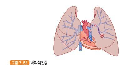 허파색전증 / 허파경색 pulmonary embolism/pulmonary infarction 허파는가스를교환하는장기이므로공기가지나가는길 ( 허파꽈리 ) 과그곳으로부터혈액속으로가스를교환하기위한미세혈관이그물코와같이퍼져있다.
