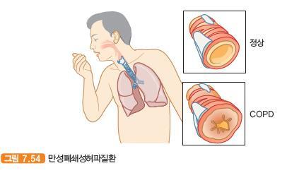 만성폐쇄성허파질환 chronic obstructive pulmonary disease 만성폐쇄성허파질환 (COPD) 은다양한이유로기도폐쇄가일어나들이마신숨을쉽게뱉어낼수없는상태가되는것이특징이다.