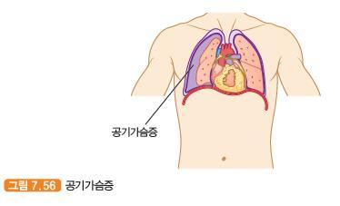공기가슴증 pneumothorax 가슴막안 ( 허파의바깥 ) 에공기나가스가들어차공기가정체되어있고, 가슴벽과허파쪽의두가슴막면이서로떨어져있는상태의질환이다. 외상성공기가슴증과자연공기가슴증으로분류된다.