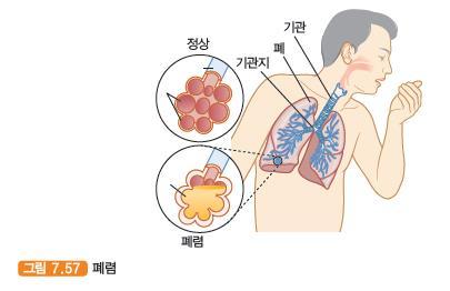폐렴 pneumonia 폐렴은세균이나바이러스, 곰팡이등의미생물로인한감염에의해발생하는합병증으로입원환자,