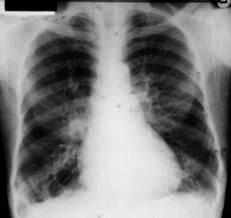 만성기관지염 chronic bronchitis 만성기관지염은적어도 3 개월동안가래를만들어내는기침을하고, 2 년에걸쳐재발되는특성이있는질환이다.