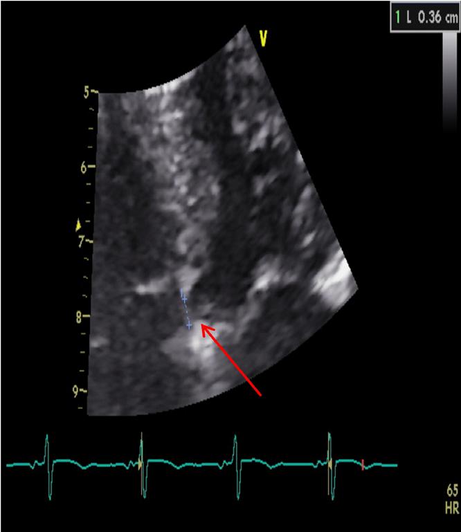 Kyoung Yong Lee, et al. VSD with massive pulmonary embolism C Figure 2.