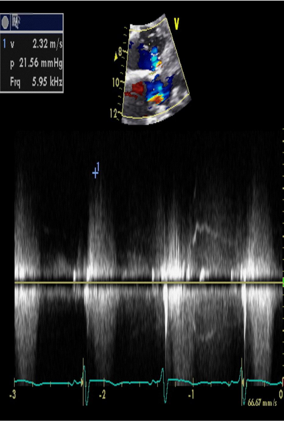 TR, tricuspid regurgitation; RVSP, right ventricular systolic pressure. Figure 3.