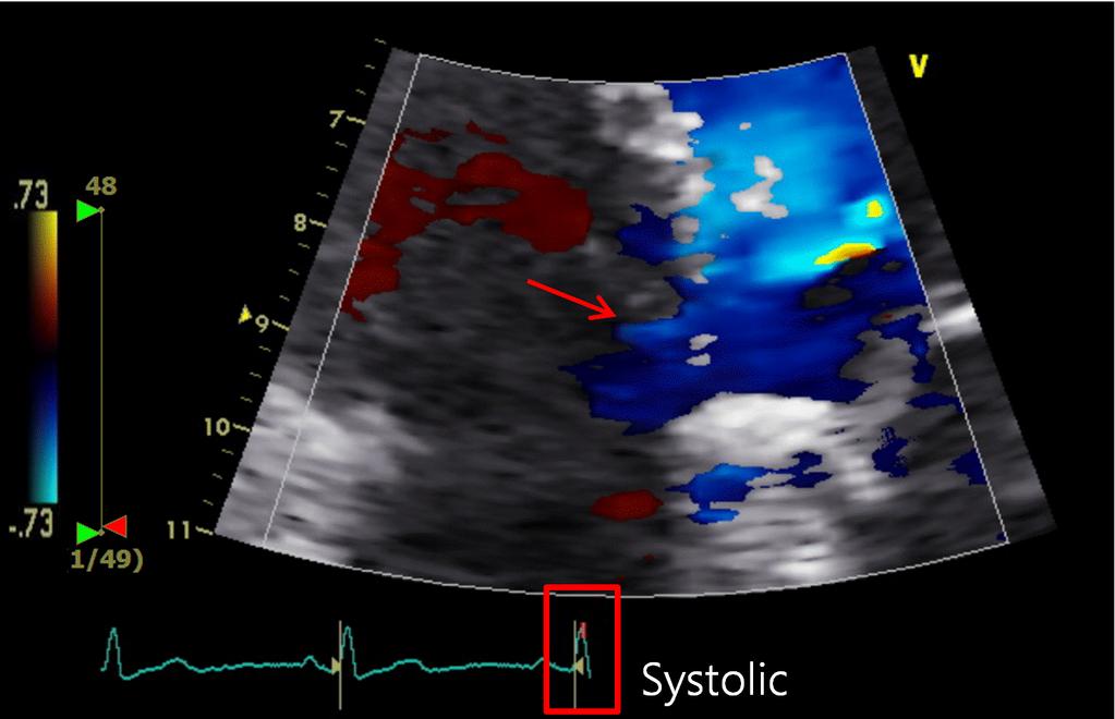 (arrow) at diastolic phase (C). TR, tricuspid regurgitation; RVSP, right ventricular systolic pressure. 고 고, 검사 결과 유의미한 근위 좌측 주가부 관상동맥(pLMC) 찰 과 근위부 우측 관상동맥(pRC)의 협착은 없었고, 폐색전증 소견 관찰되었다.