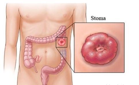 장루 ( stoma) 1.