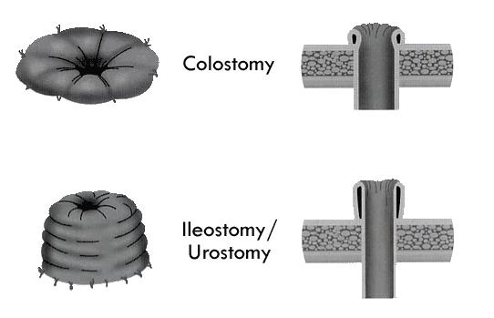 Stoma 29