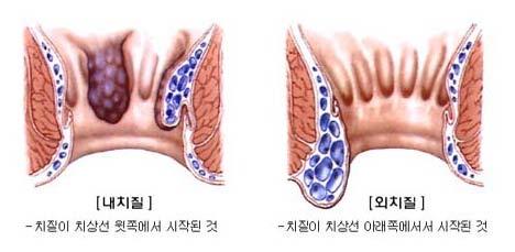 치질