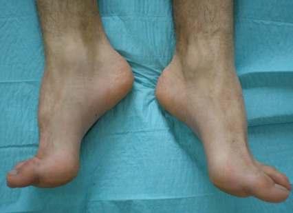 forefoot Exaggeration of early