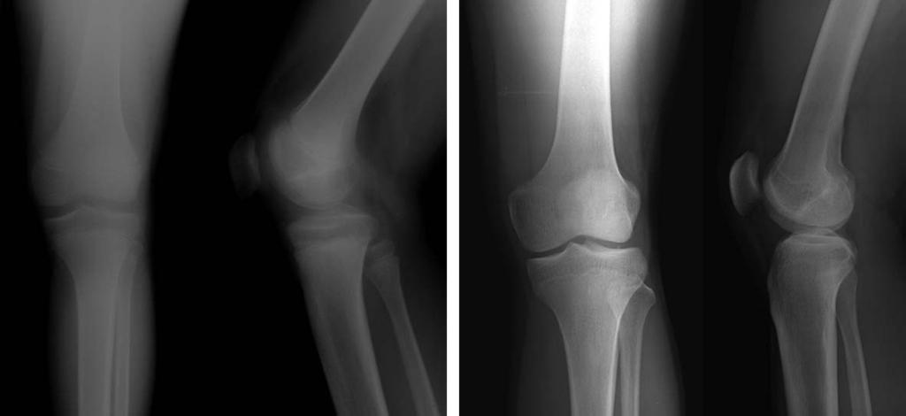 ulnar 1 Total 8 A Fig. 1. A 5-year-old girl with left hip pain. (A) Preoperative hip anterior-posterior view and axial view shows chondroblastoma at epiphysis of the femoral head.