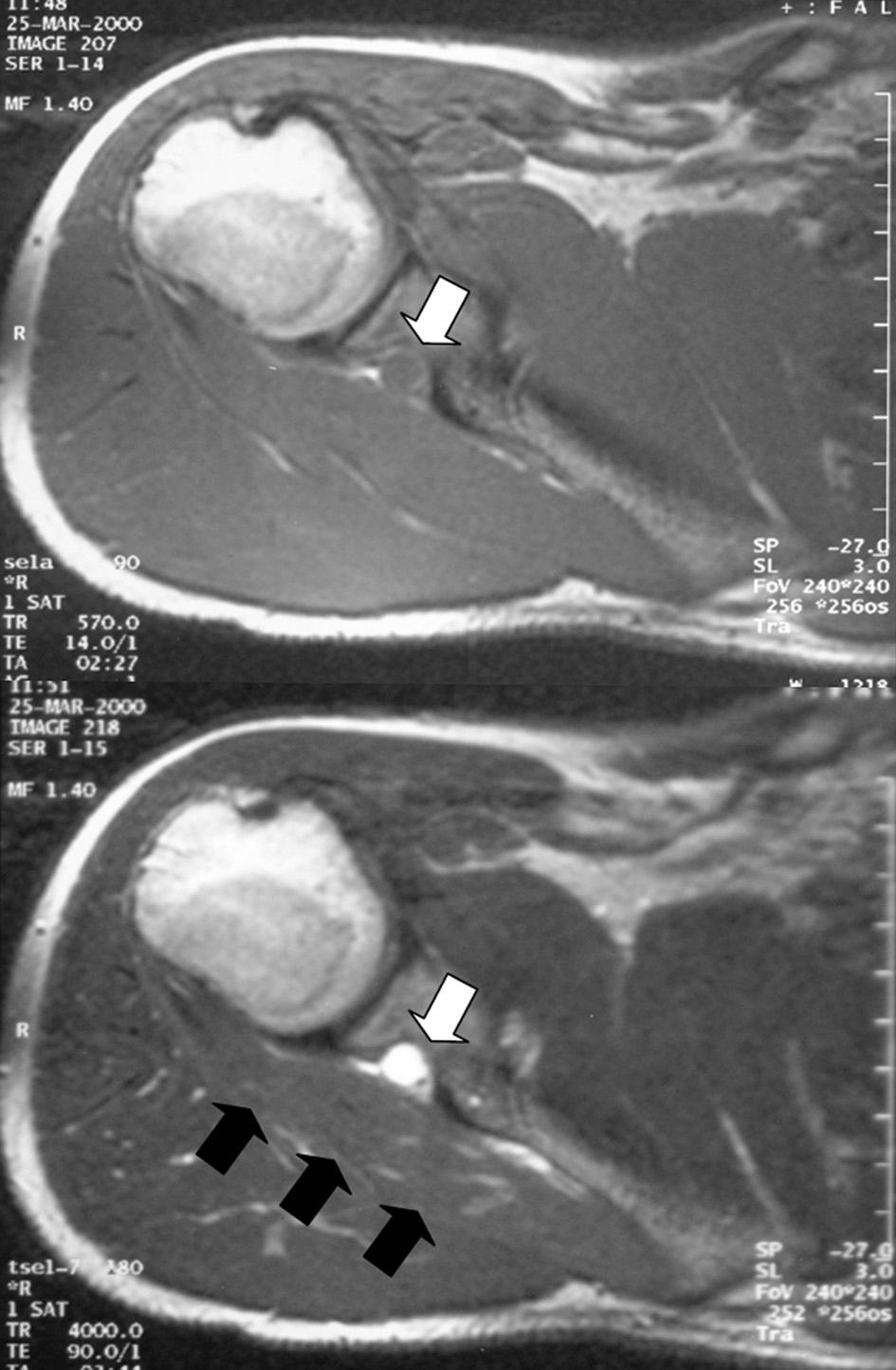 Fig. 12. Diagram of suprascapular nerve passage viewing from the back. (SSN; suprascapular nerve, SSM; supraspinatus muscle, ISM; infraspinatus muscle) Fig. 13.