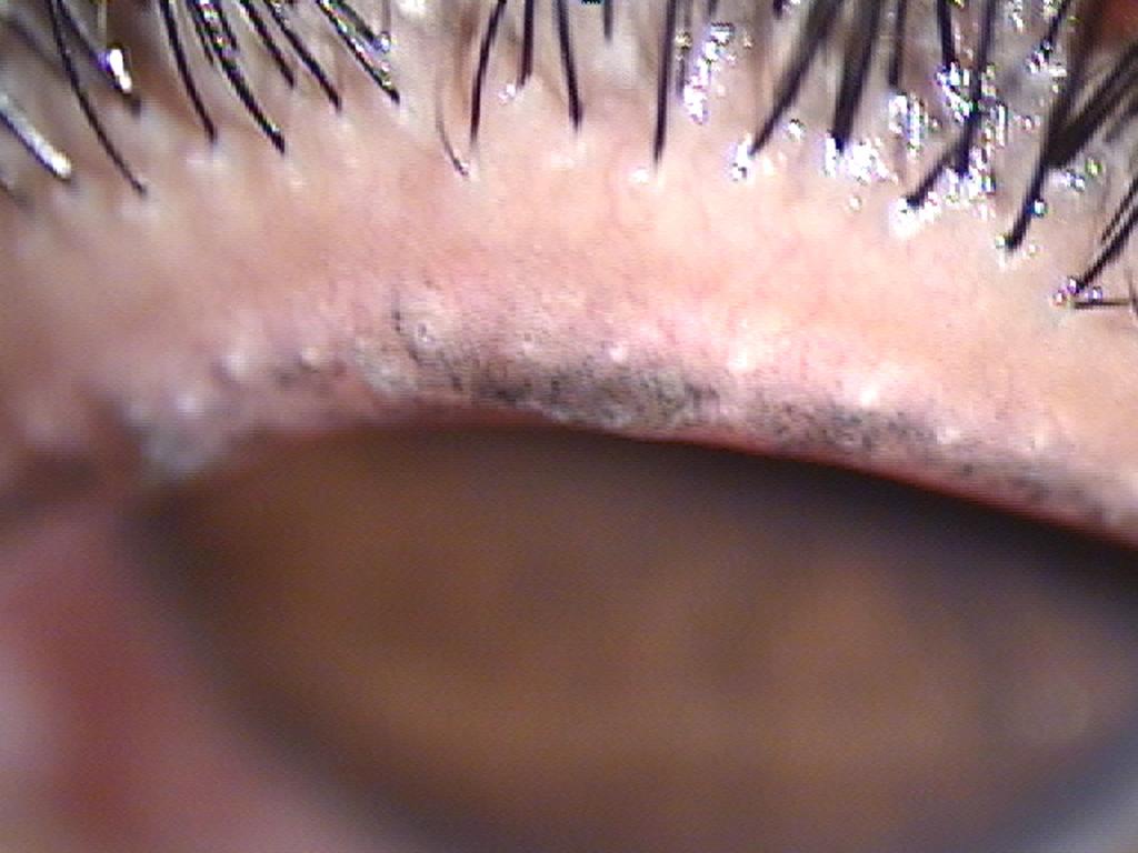 Photograph shows cosmetic tattoo at inner margin of