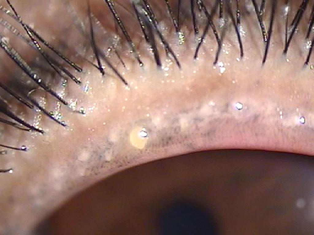 after eyelid tattooing. Figure 3.