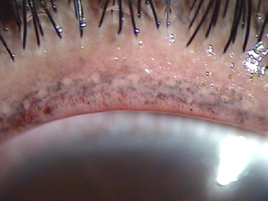 margin of eyelid and severe meibomian gland