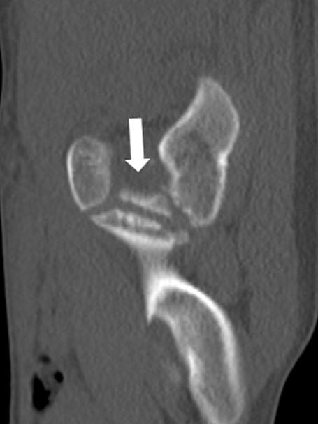 골반방사선사진상 tear drop의확장, 경한치골의저형성증이관찰되었고삼방연골손상부위에는골가교가형성되었다 (Fig. 3).