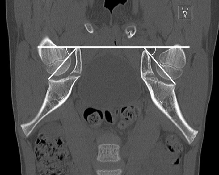 (B) At the final follow-up CT coronal view, right/left inclination was measured as 48/50 degree. Table 1.