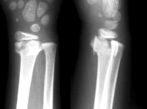 (C) Radiographs taken 5 years and 5 months after trauma show satisfactory results. This patient showed no clinical complications at the last follow up. 변이역시 2 mm 이내를보였다.