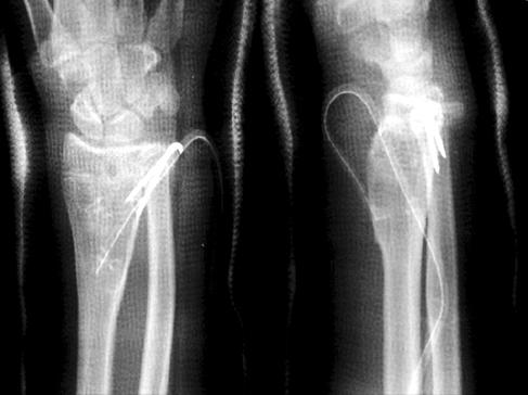 inclination and 15 o of volar tilting, due to central bar formation of the distal radial physis.