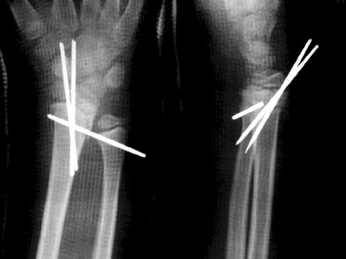 (E) 2 years and 6 months after surgery, the radius again observed to be 5 mm shorter than the ulna.