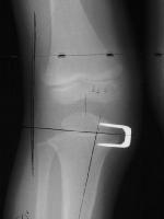 PHYSEAL ARREST Management Osteotomy Bar excision Arrest of remaining physis Shoe lift