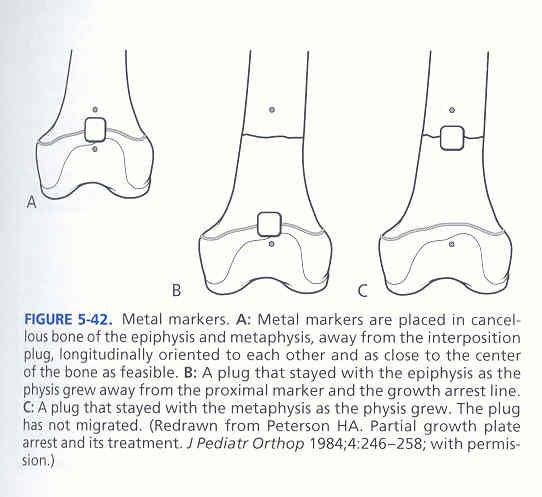 PHYSEAL ARREST Technique Do not undermine epiphysis and metaphysis