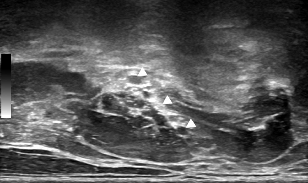 nterior scalene muscle (SM) is deep to sternocleidomastoid muscle (SM) and lateral to the internal jugular vein. Middle scalene (MSM) is found further postero-lateral.