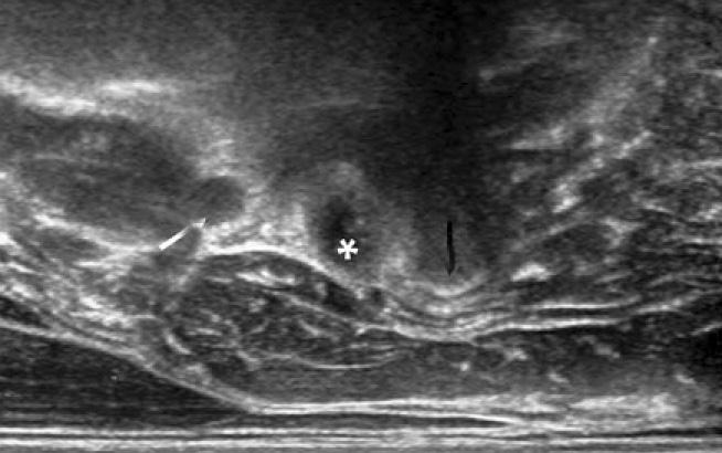 Open arrow indicates low, round posterior tubercle and asterisk is 6 root.