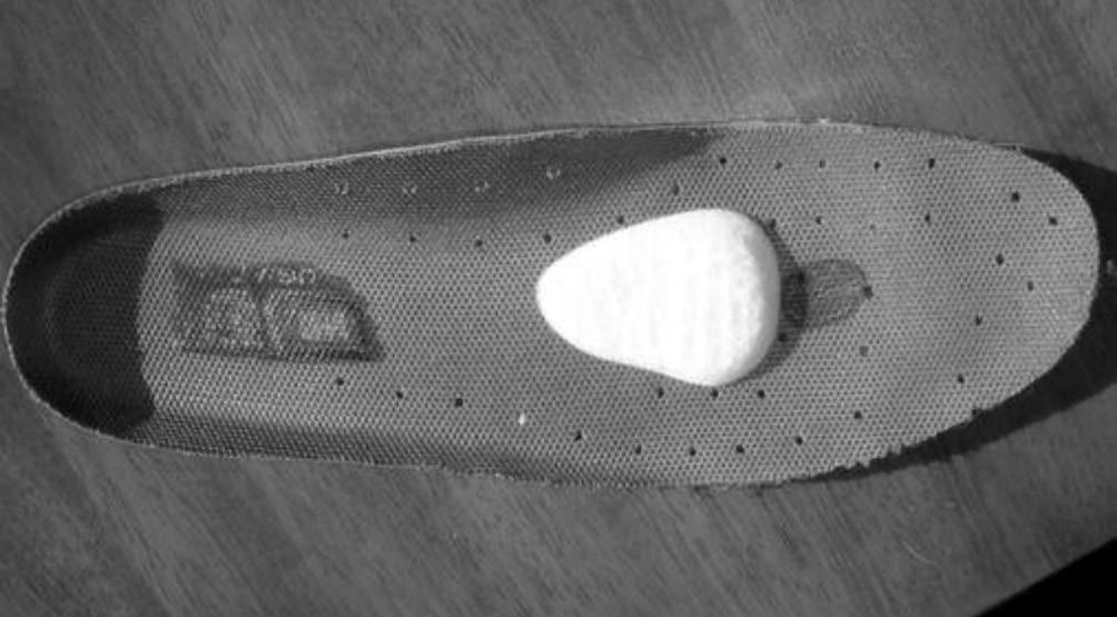 301 Figure 6. A soft metatarsal pad is added to the insole just proximal to the metatarsal head region, which helps to spread the metatarsal heads to relieve pressure on the nerves.