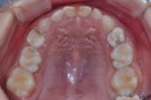 Kyung Jin Kim, et al : General Anesthesia for Dental Treatment of a Pediatric Patient with Marfan Syndrome 교합, 치주질환및치아우식의증가등이관찰될수있다 [1,2]. 대부분의임상증상이환자가나이와함께명확해지는양상을보이므로 10세이전에임상증상만으로진단하기는어려울수있다 [3].