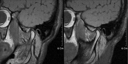 교근, 측두근및경부근육, 턱관절부위를촉진하였을때압통은존재하지않았으며, 파노라마방사선사진 (panoramic X-ray) 검사상특기할골변화소견은관찰되지않았다 (Fig. 1).