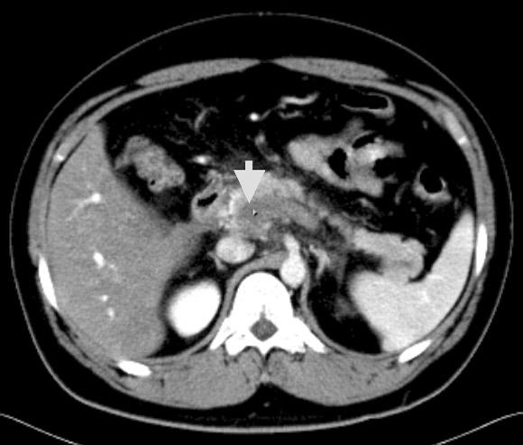 대한류마티스학회지제 14 권제 4 호 2007 Fig. 1. Extensive portal vein thrombosis found on abdominal CT scan. (A) Entire right intrahepatic portal vein is occluded by thrombosis.