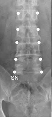 J Korean Med Assoc 2014 April; 57(4): 308-317 A Figure 1. Lumbar medial branch block. (A) Anterior-posterior view.