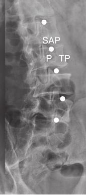 (A) An anterior-posterior radiograph shows the dots which rest on the concave lateral surface of the articular pillar (ap) of the each cervical vertebrae. (B) A lateral view of the cervical spine.