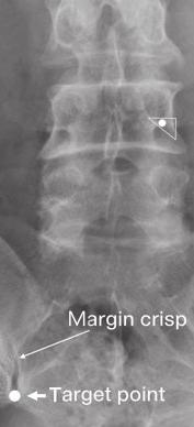 Shin DA Kim HI Spinal interventions Figure 3. Third occipital nerve block. A lateral view of the upper cervical spine showing the target points for third occipital nerve blocks.