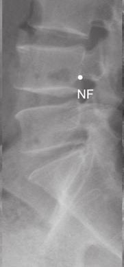 The three target points lie at the intersections of the axial ine and transverse lines through the apex of the C3 superior articular process, tangential to the bottom of the C2-3 intervertebral