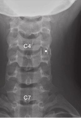 J Korean Med Assoc 2014 April; 57(4): 308-317 는다. C형방사선투시기의사위상에서골간인대부위를확인한다. 입점은대부분천골의정중부에위치한다. C형투시기의각도와평행하게탐침을진행시켜골간인대내로탐침을삽입시킨다. 조영제를투입하여천장골관절근처의확산을확인한후 0.75% 로피바카인또는 0.