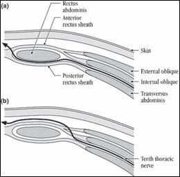 Rectus muscle 주위의 신경주행 경로 복벽의 감각을 담당하는 신경은 T7-L1에서 나오고 대부분 intercostal nerve의 주행방향을 그대로 이어 받게 된 다.