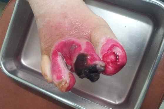 당 한양방 병행치료로 호전된 Fig Diabetic foot 뇨병성 infection 족부감 례 염 환자 증 ulceration of 보고 patient (0 영상의학검사 (