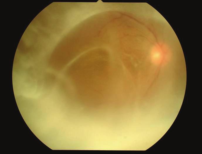 2A), 모든경우에서동일부위에형광안저촬영상망막색소상피 (retinal pigment epithelium) 의간섭부위의저형광반점이고형광과함께나타나는것 을확인할수있었다 7 (Fig. 2B). 이중 1명 (1안) 은망막하침윤이큰종괴의양상으로나타났다 (Fig. 3A).