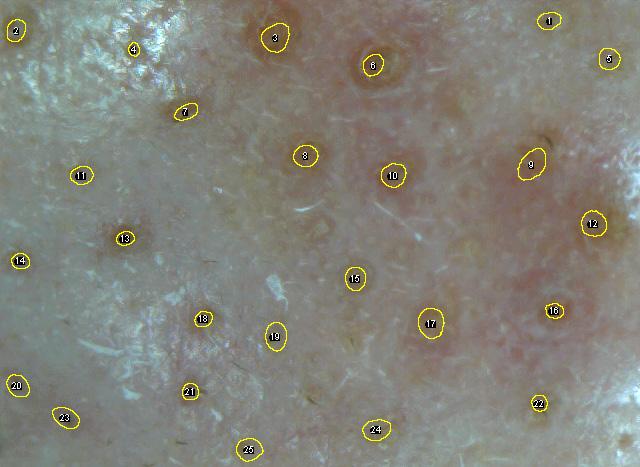 Microscope camera와 image J를통한모공분석법개발 Image J에서 microscope camera를이용하여측정한모공사진을불려오고, 불러온영상을분석에최적화하기위해 서 Gaussian blur를적용하였다. 이후각각의모공의위치를찾기위해서 noise tolerance 기능을적용하여모공위치를추출한다.