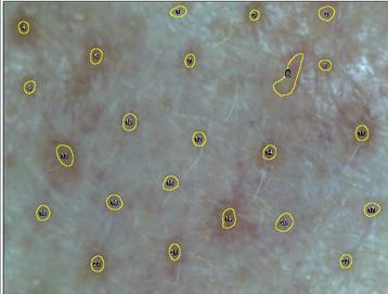 Figure 2. Elevation of skin pore size using cosmetic full-face photography system. Figure 3. Elevation of skin pore size using Image J. Figure 4. Elevation of aging degree using Image J.