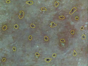 동일한조건에서 microscope camera와 image J를이용하여분석한결과사용전 613.417 AU, 사용후 436.13 AU로감소하였고, 28.90% 개선율을나타냈다 (Figure 3, Table 1).