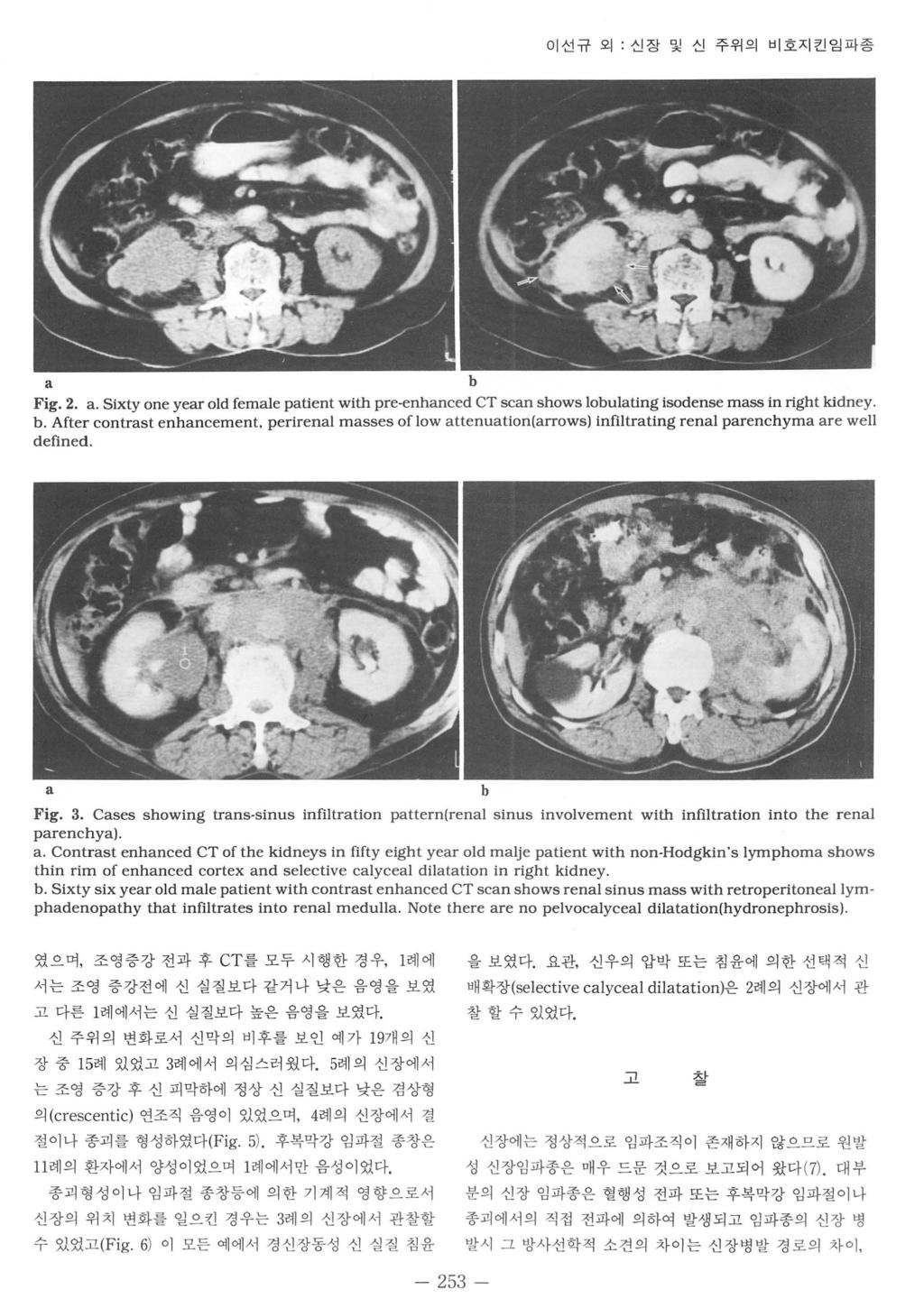 이선규외. 신장및신주위의비호지킨임파종 a b Fig.2. a. Sixty one year old female patient with pre-enhanced CT scan shows lobulating isodense mass in right kidney. b. After contrast enhancement.