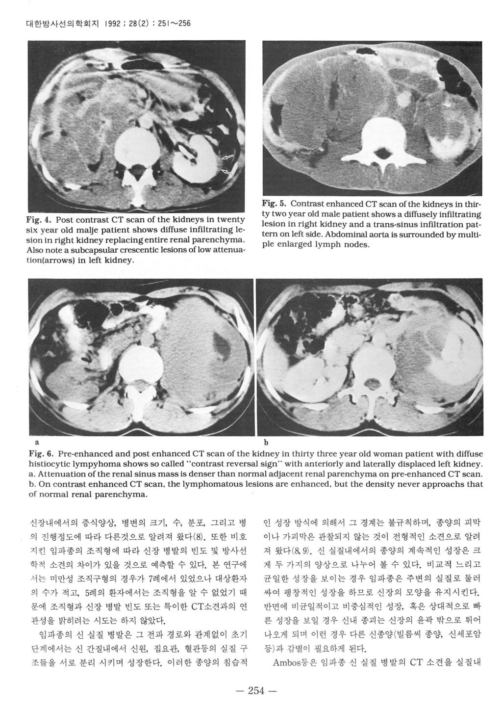 대한방사선의학회지 1992 ; 28 (2) : 251 ~256 Fig.4. Post contrast CT scan of the kidneys in twenty six year old malje patient shows diffuse infi\trating lesion in right kidney replacingentire renal parench yma.